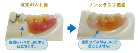 従来の入れ歯とノンクラスプ義歯との比較